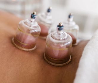 Vier cuppingtherapiecups worden met zuigkracht op de rug van de persoon geplaatst.
