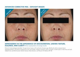 before and after chemical peel photos