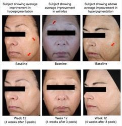 Chemical Peels - Haber Dermatology