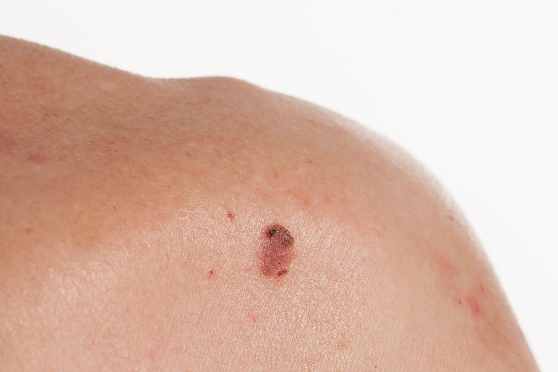 cancerous squamous cell carcinoma on shoulder