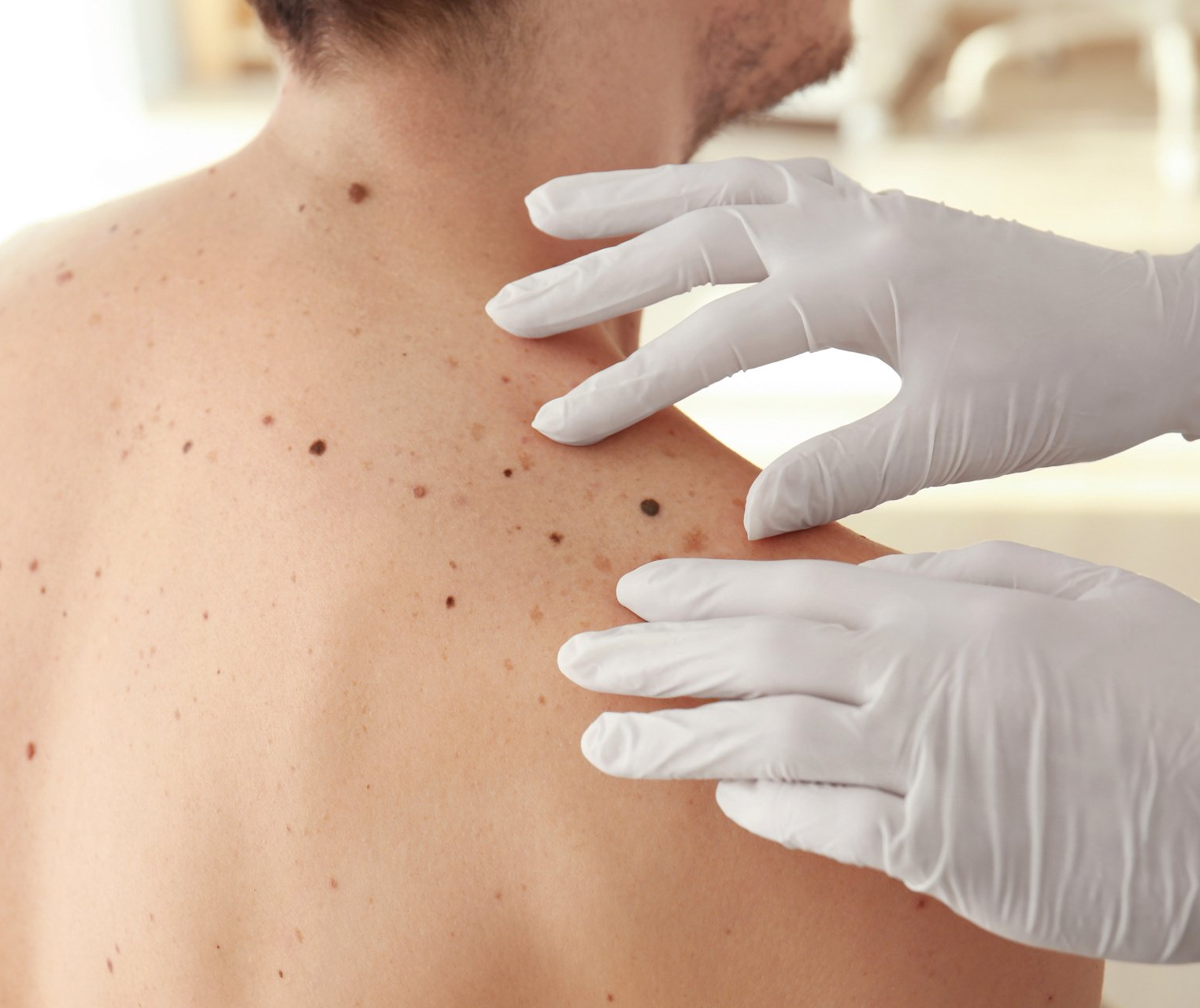 doctor examines moles on male patient's back