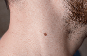 closeup of mole on neck
