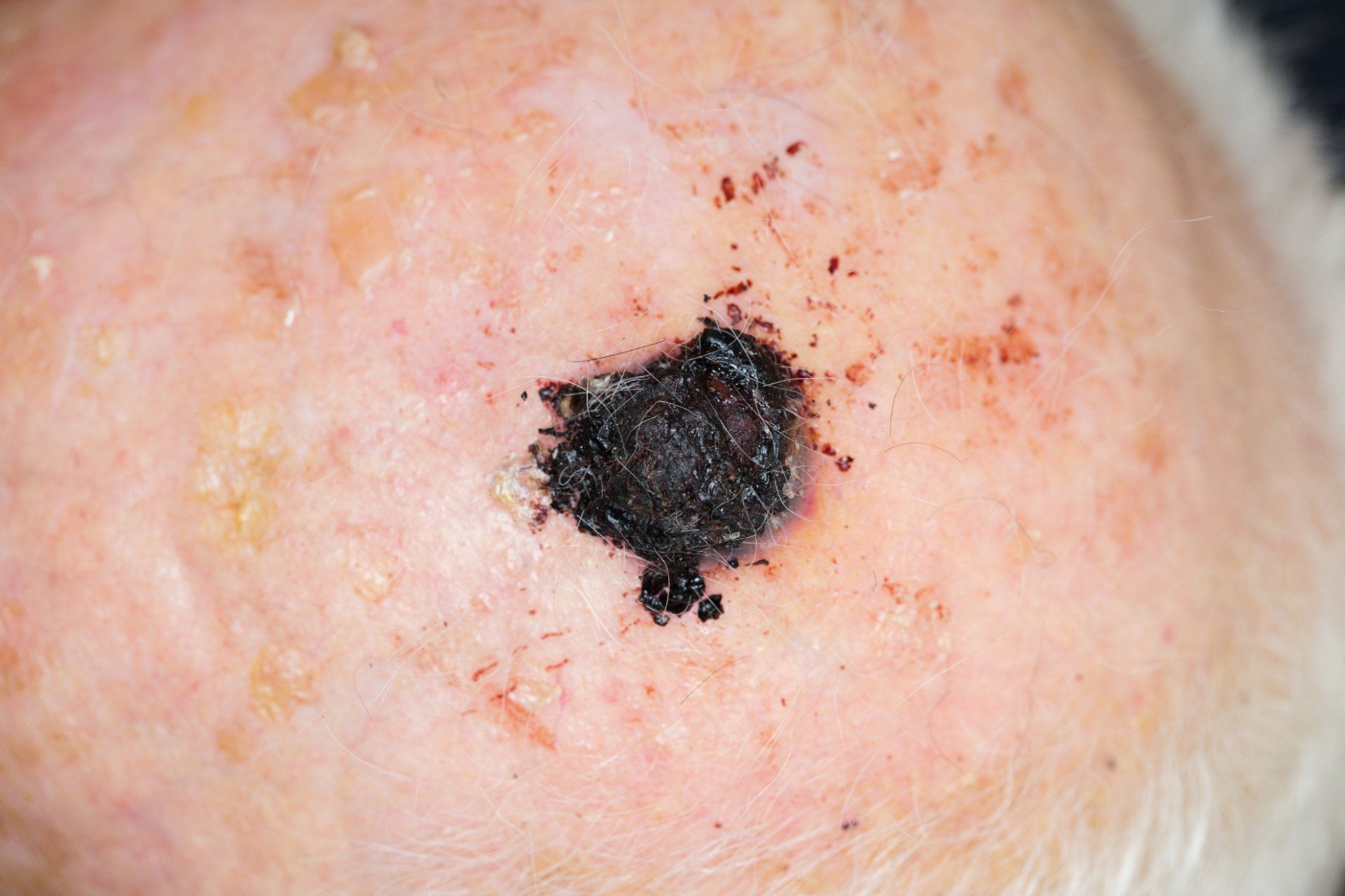 malignant melanoma on scalp of elderly man
