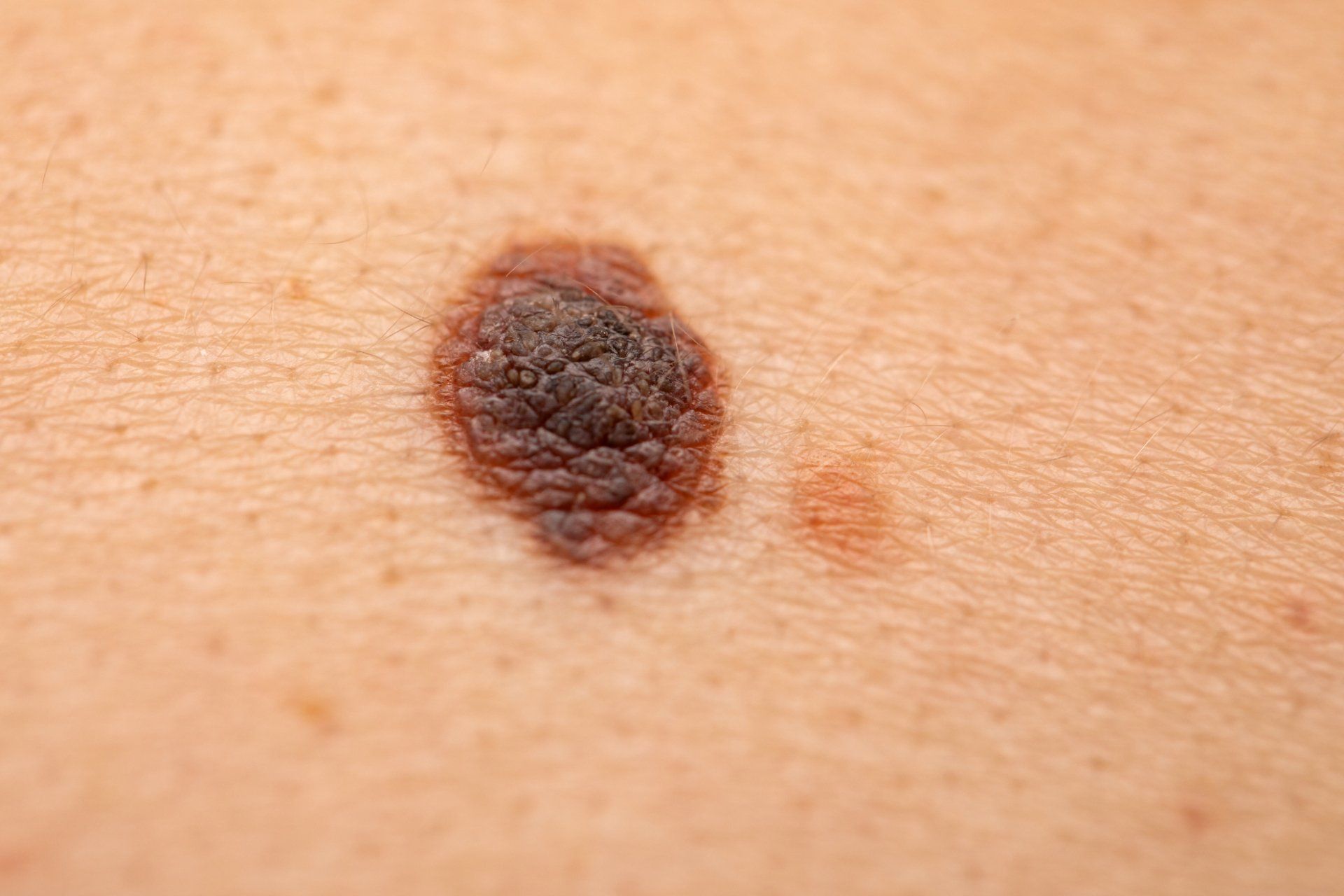 close up of skin cancer spot