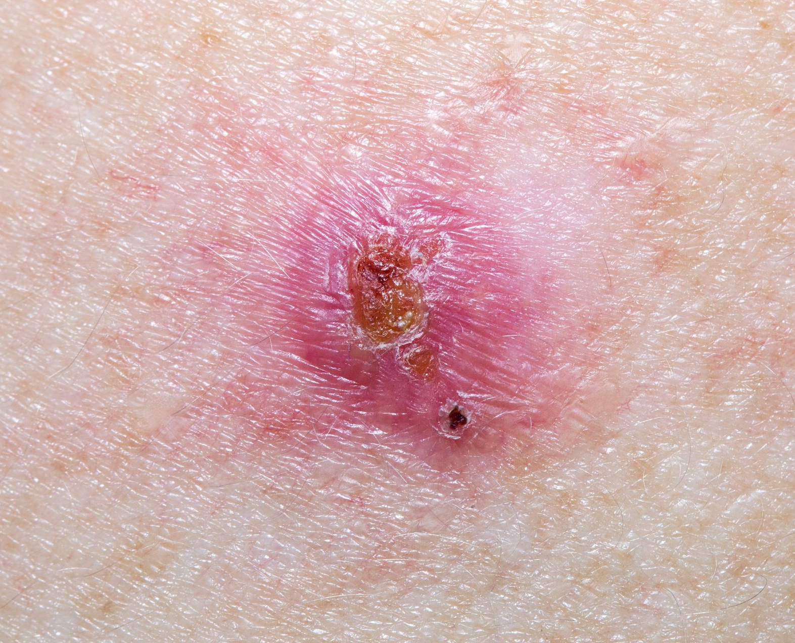 basal cell carcinoma scaly spot