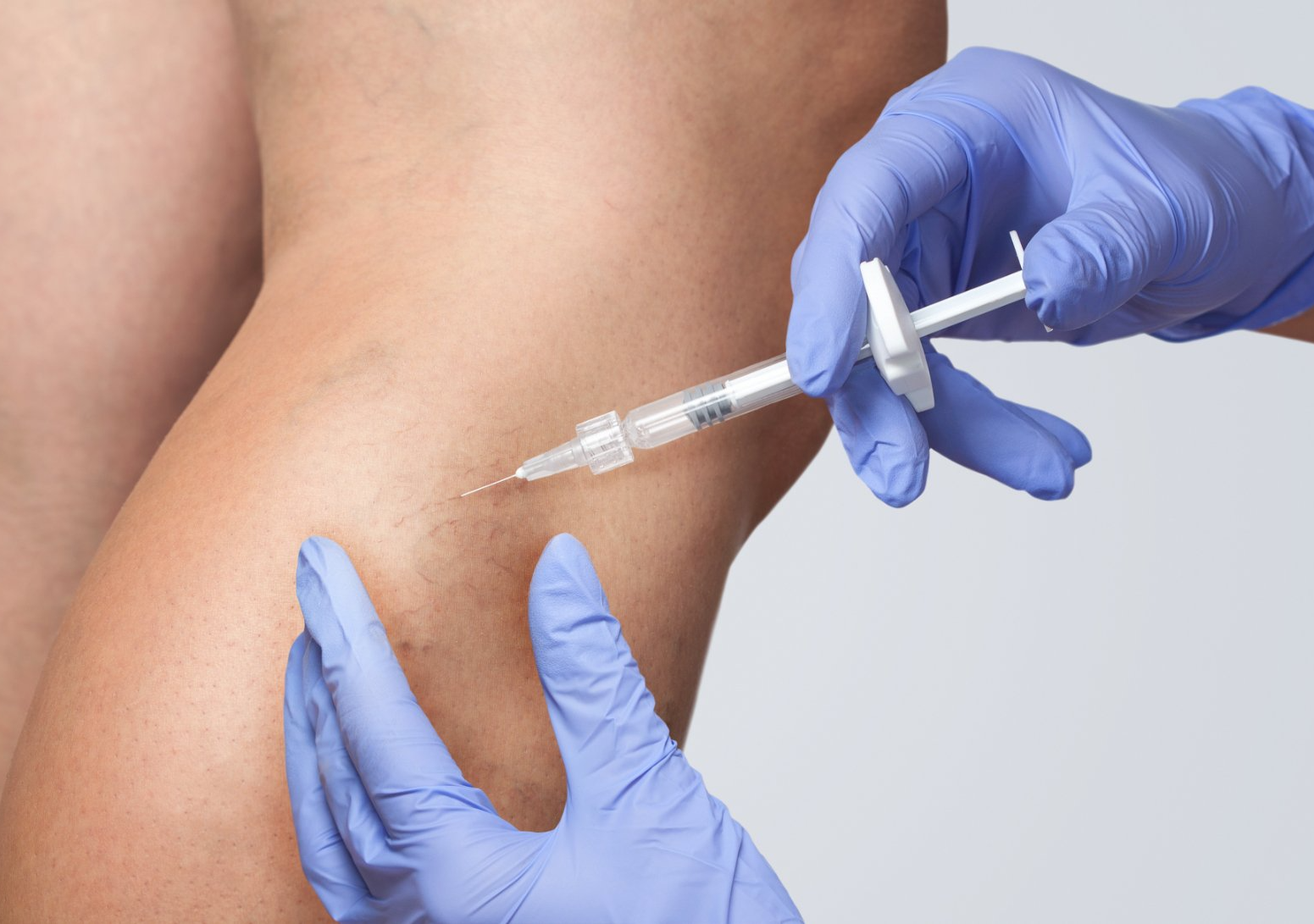 closeup of sclerotherapy injection
