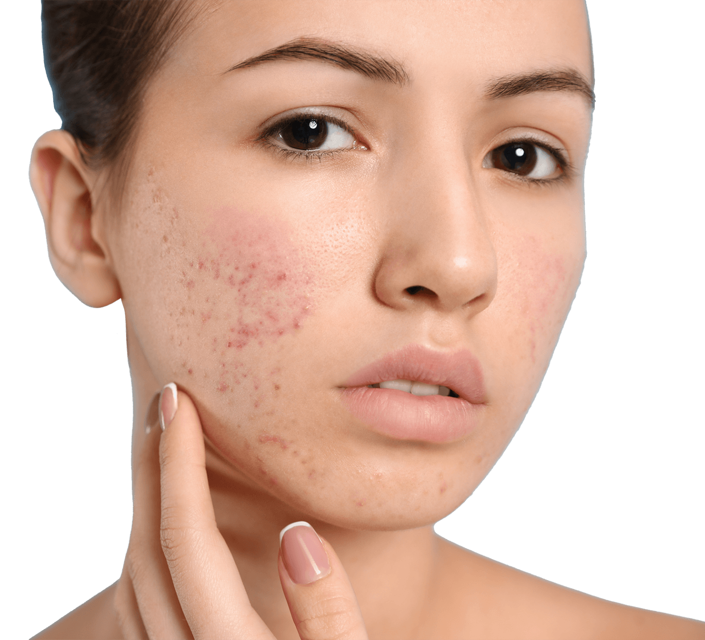 woman with acne on cheeks