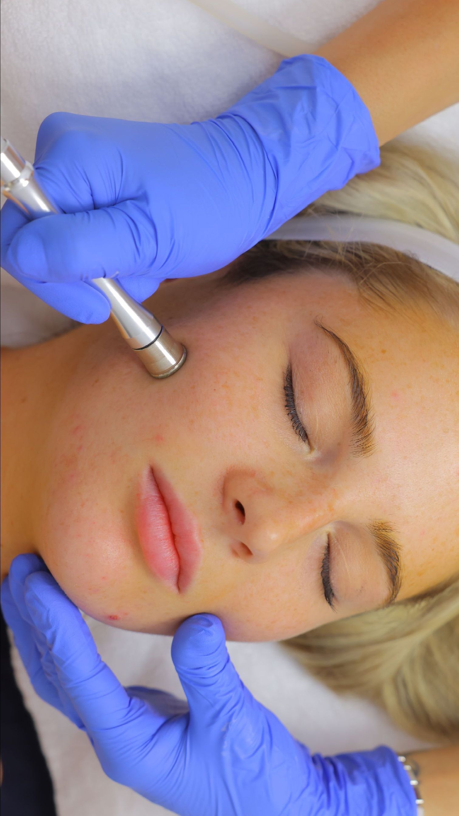 woman getting microdermabrasion