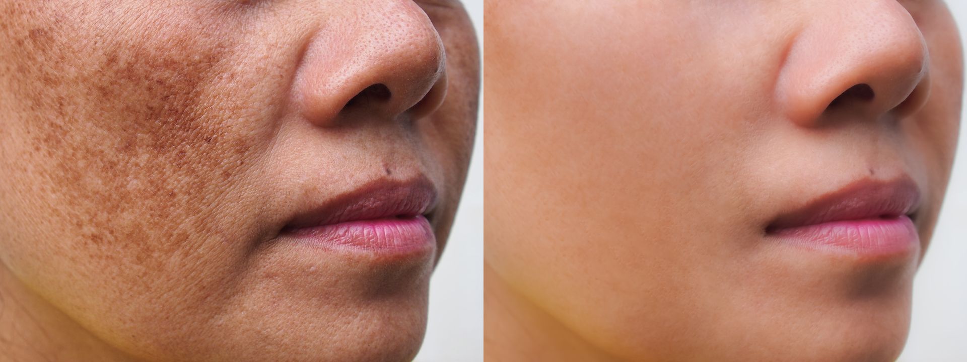 A before and after photo of a woman 's face with dark spots.