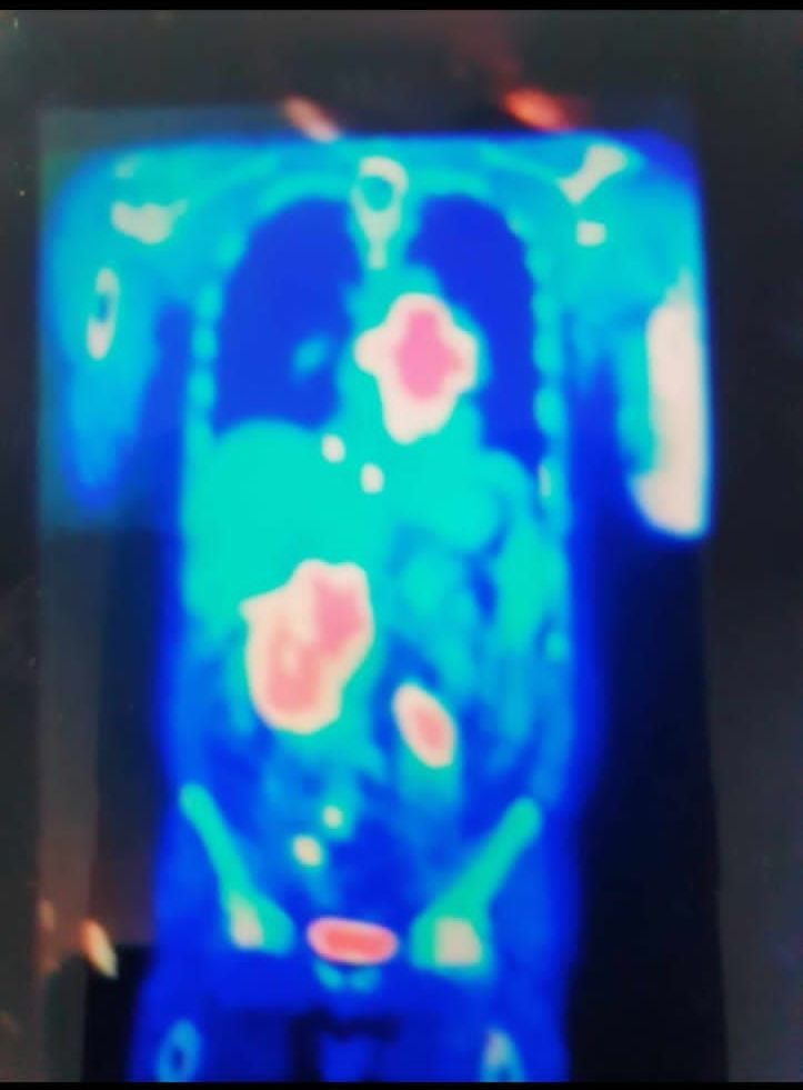 A ct scan of a person 's chest and abdomen