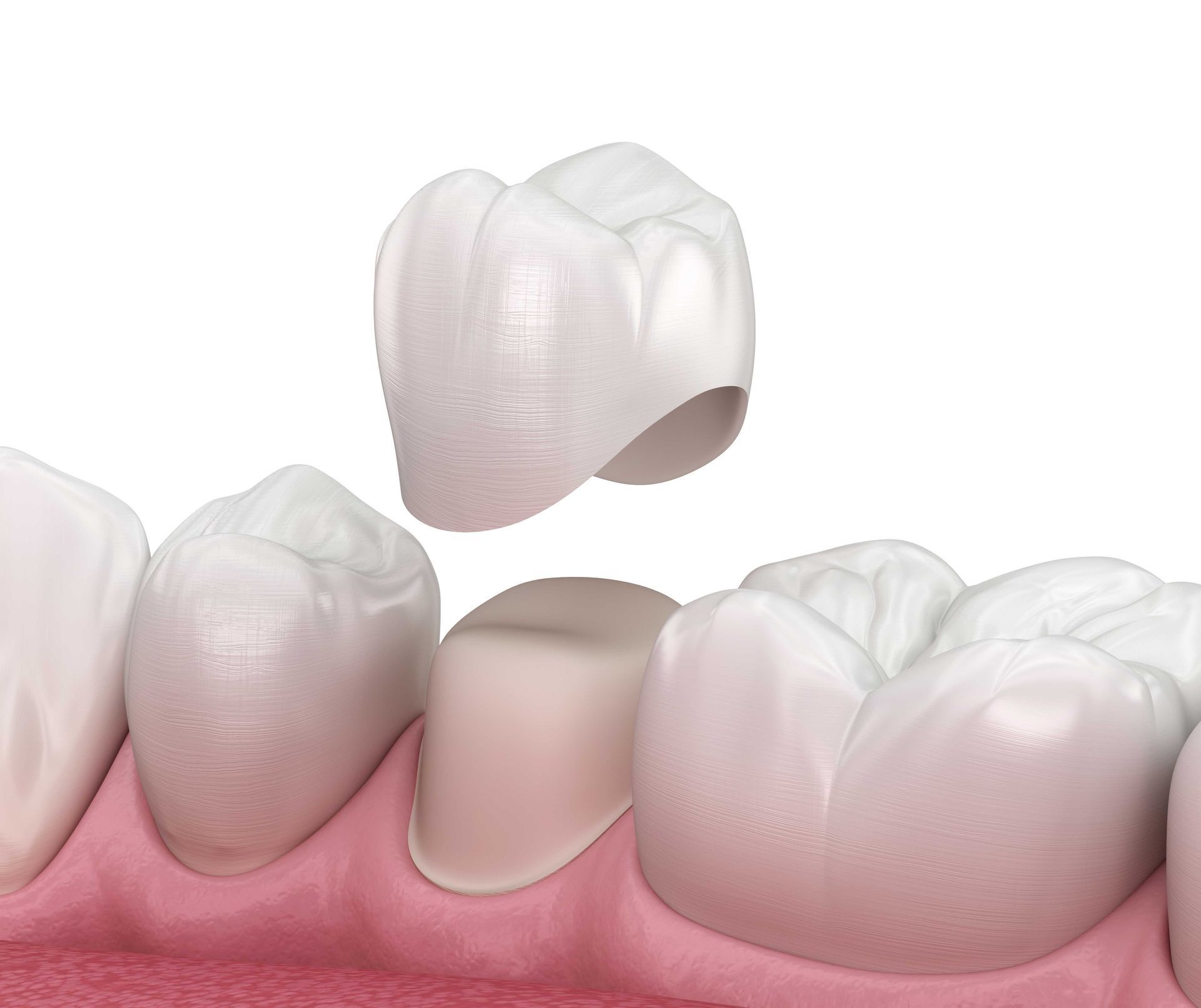 Adventure Smiles Dental & Orthodontics in Houston - A dental crown is being placed on a tooth.