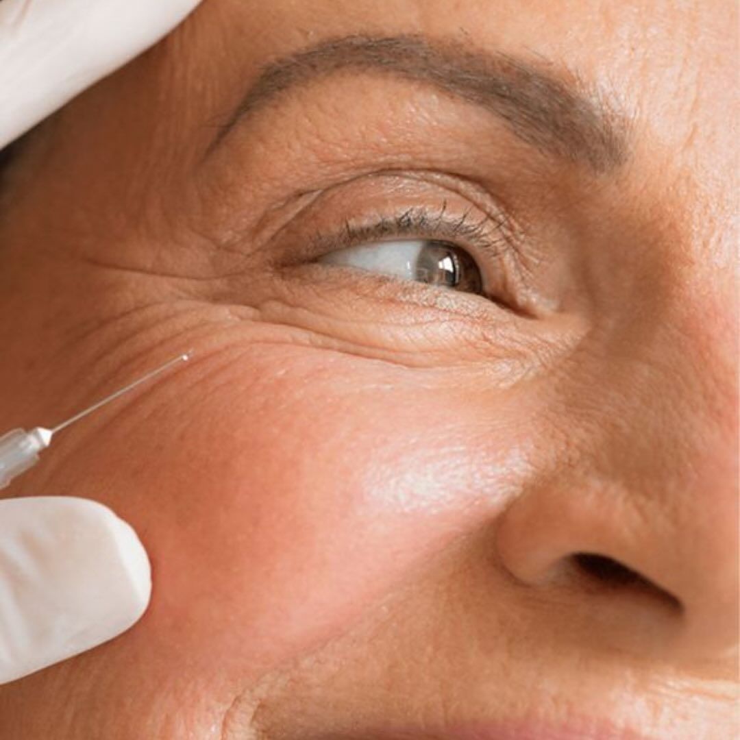 Close-up of a person's face receiving cosmetic injections near the eye. A gloved hand holds the syringe.— Skin Haven Aesthetics Whitsundays in Airlie Beach, QLD