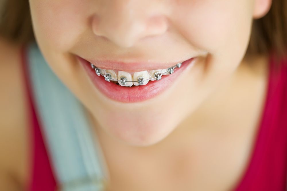 Close-up of a Smiling Mouth With Metal Braces on the Teeth — Tamworth Orthocare In Gunnedah, NSW