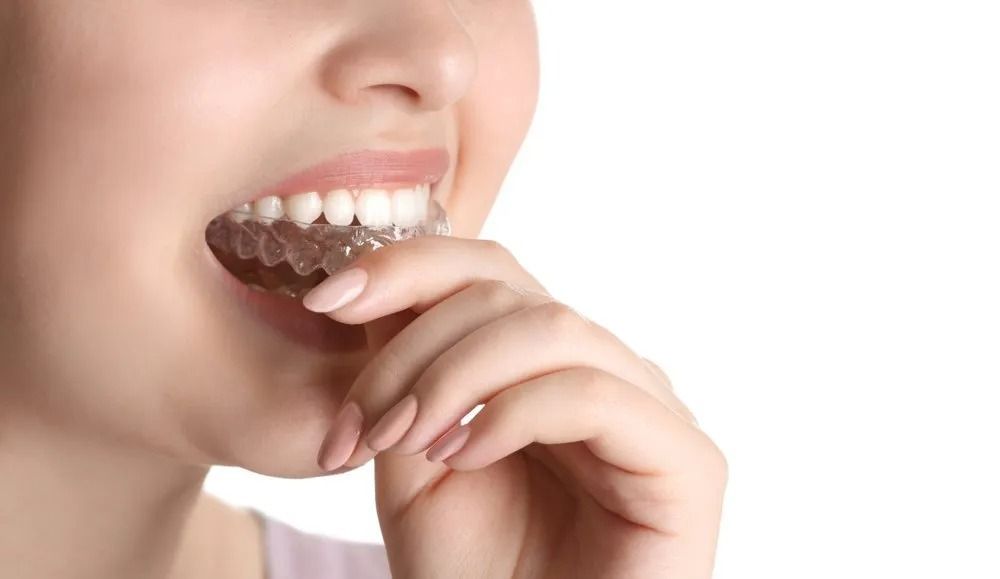 Woman Inserting Clear Dental Aligner Into Mouth — Tamworth Orthocare In Tamworth, NSW