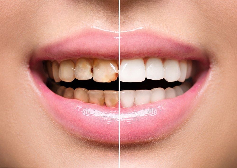 Teeth Whitening Comparison: One Half Shows Stained Teeth — Tamworth Orthocare In Tamworth, NSW