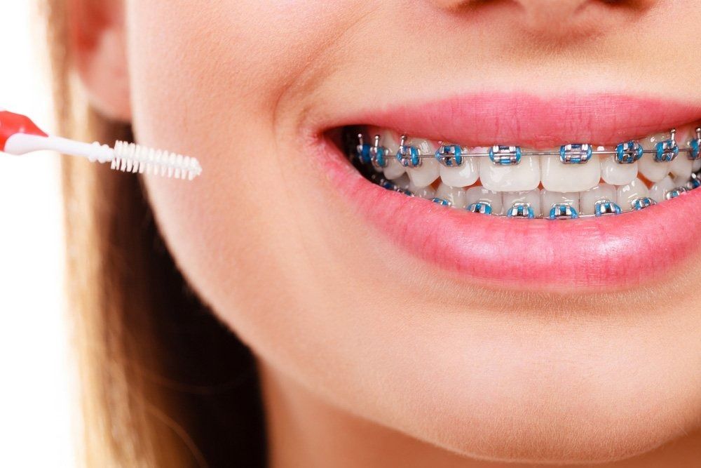 Person With Braces Cleaning Teeth With — Tamworth Orthocare In Tamworth, NSW
