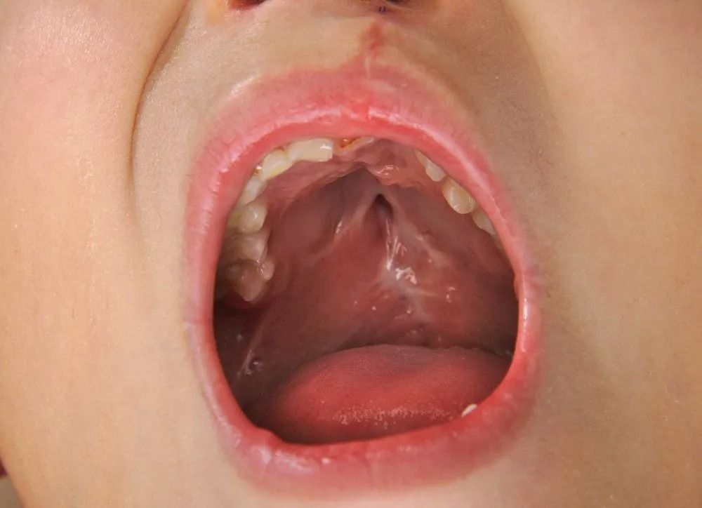 Open Mouth Showing Cleft Palate — Tamworth Orthocare In Tamworth, NSW