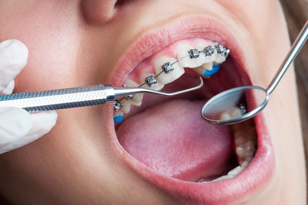 Mouth With Braces Being Examined With Dental Tools — Tamworth Orthocare In Narrabri, NSW