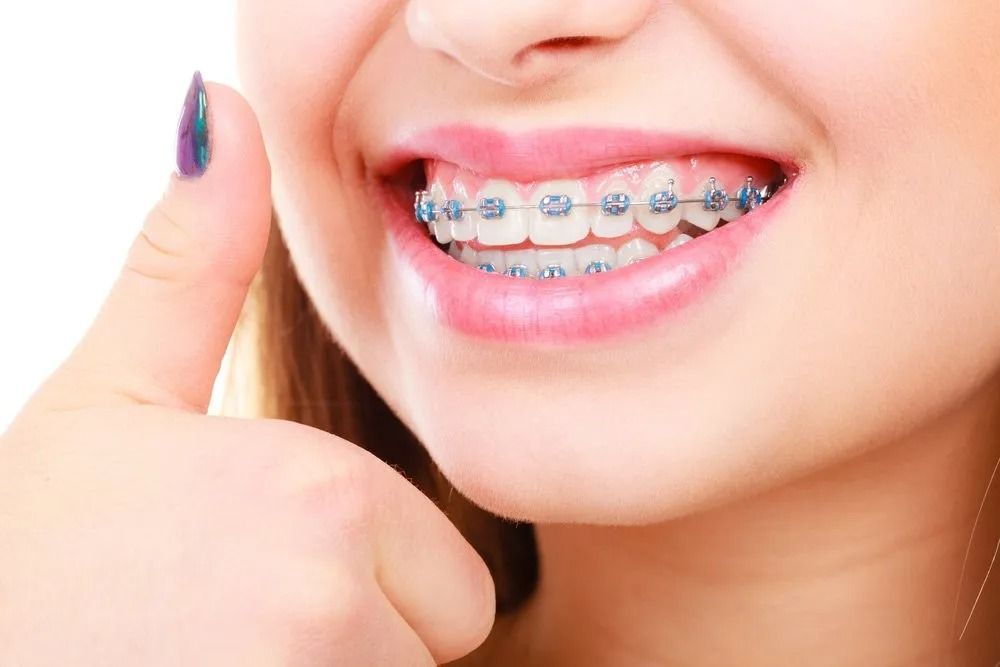 Smiling Person With Blue Braces, Giving a Thumbs Up, Showing Teeth — Tamworth Orthocare In Tamworth, NSW