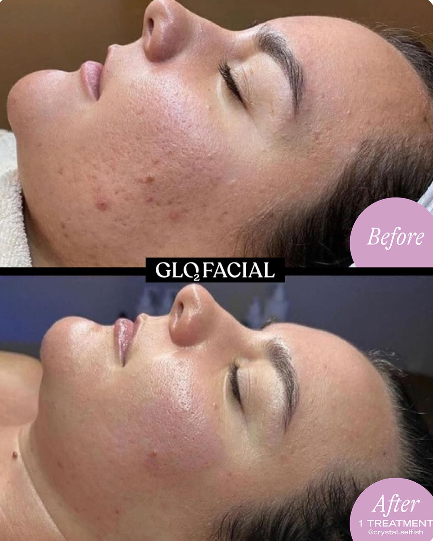 Before-and-after side profile of a facial treatment on a resting person, with “Before” and “After” labels.