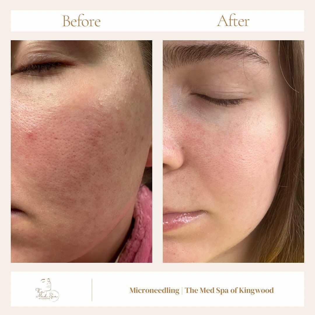 Before-and-after close-up of cheek skin showing redness and texture improvement after microneedling.