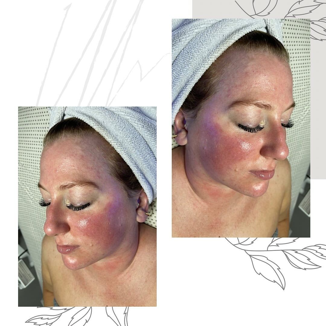 Side-by-side close-ups of a woman's face with red, shiny skin, shown in a towel