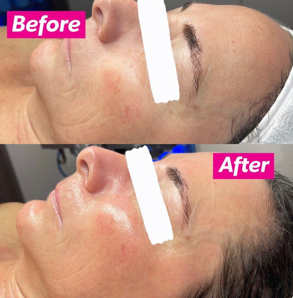 Before-and-after close-up of a facial treatment, showing smoother, glossier skin after treatment.