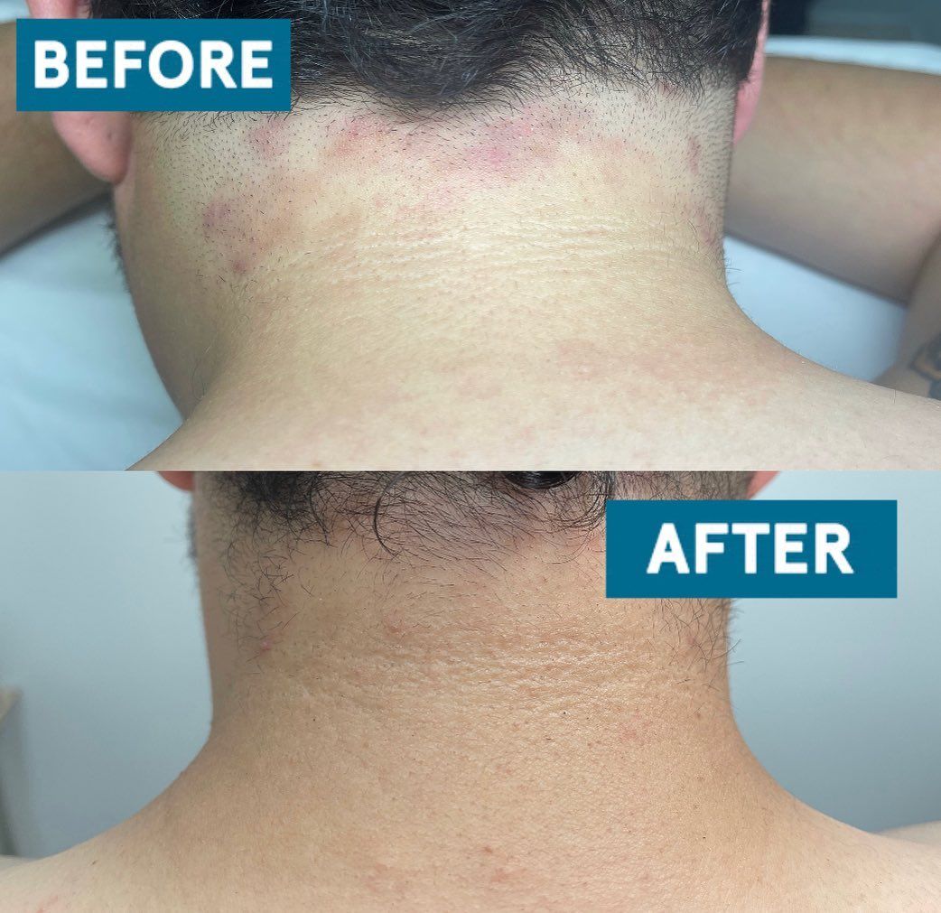 Before-and-after close-up of the back of a neck with a skin rash improved after treatment