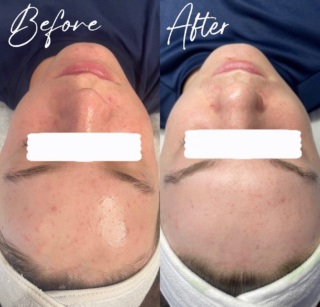 Side-by-side before and after close-up of a chin and lower face with reduced redness and hair growth.