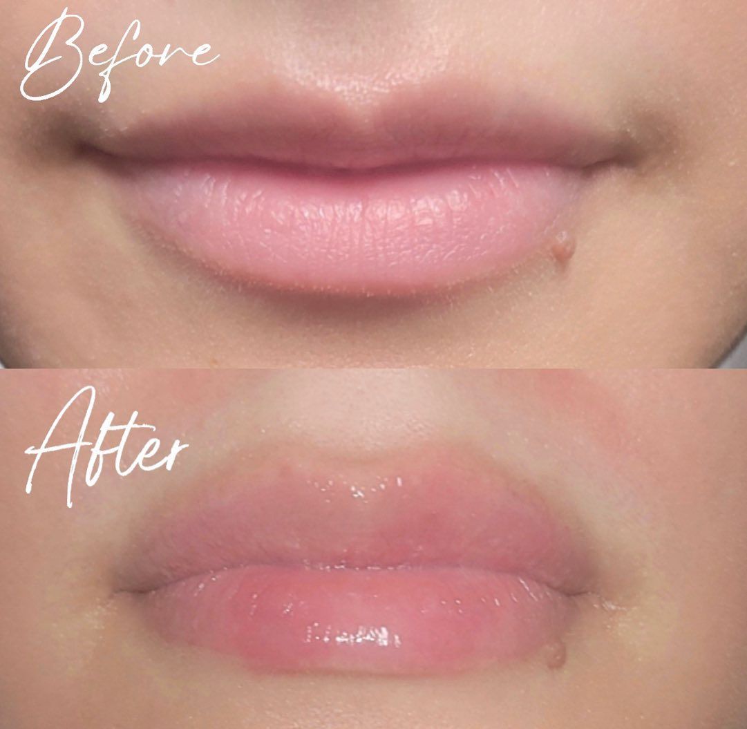 Before-and-after close-up of lips, showing a pinker, glossier finish after treatment.