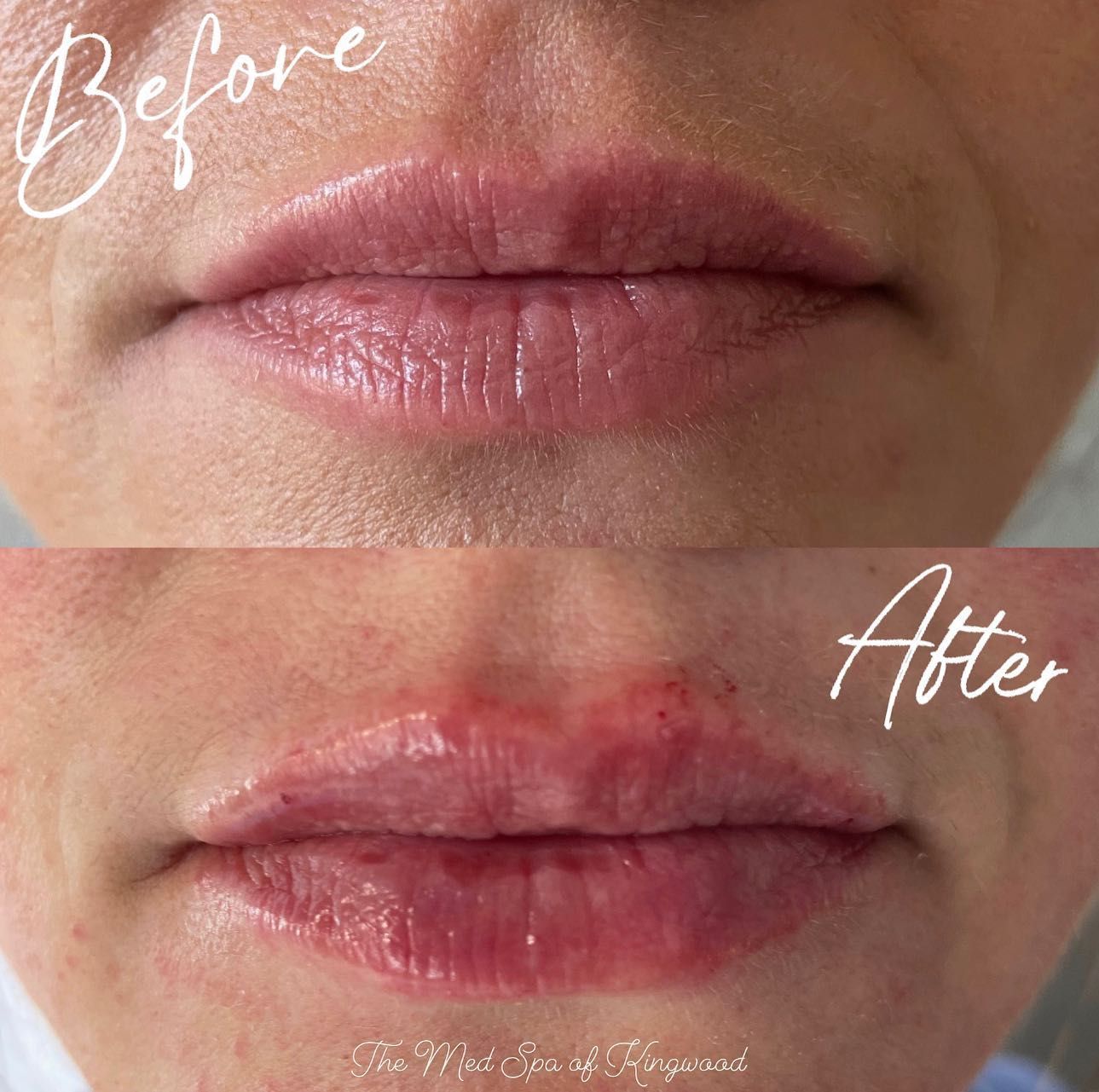 Before-and-after close-up of lips, showing a red, irritated lower lip in the after image.
