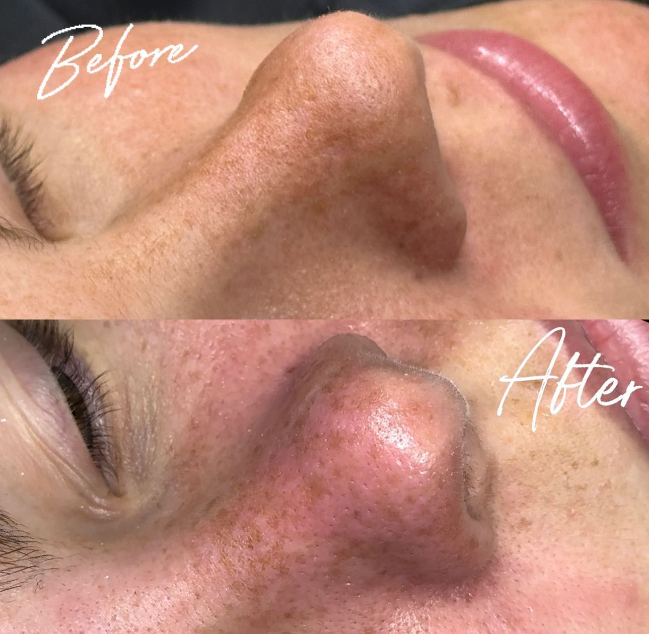 Side-by-side before-and-after close-up of a nose, showing reduced redness and smoother skin.