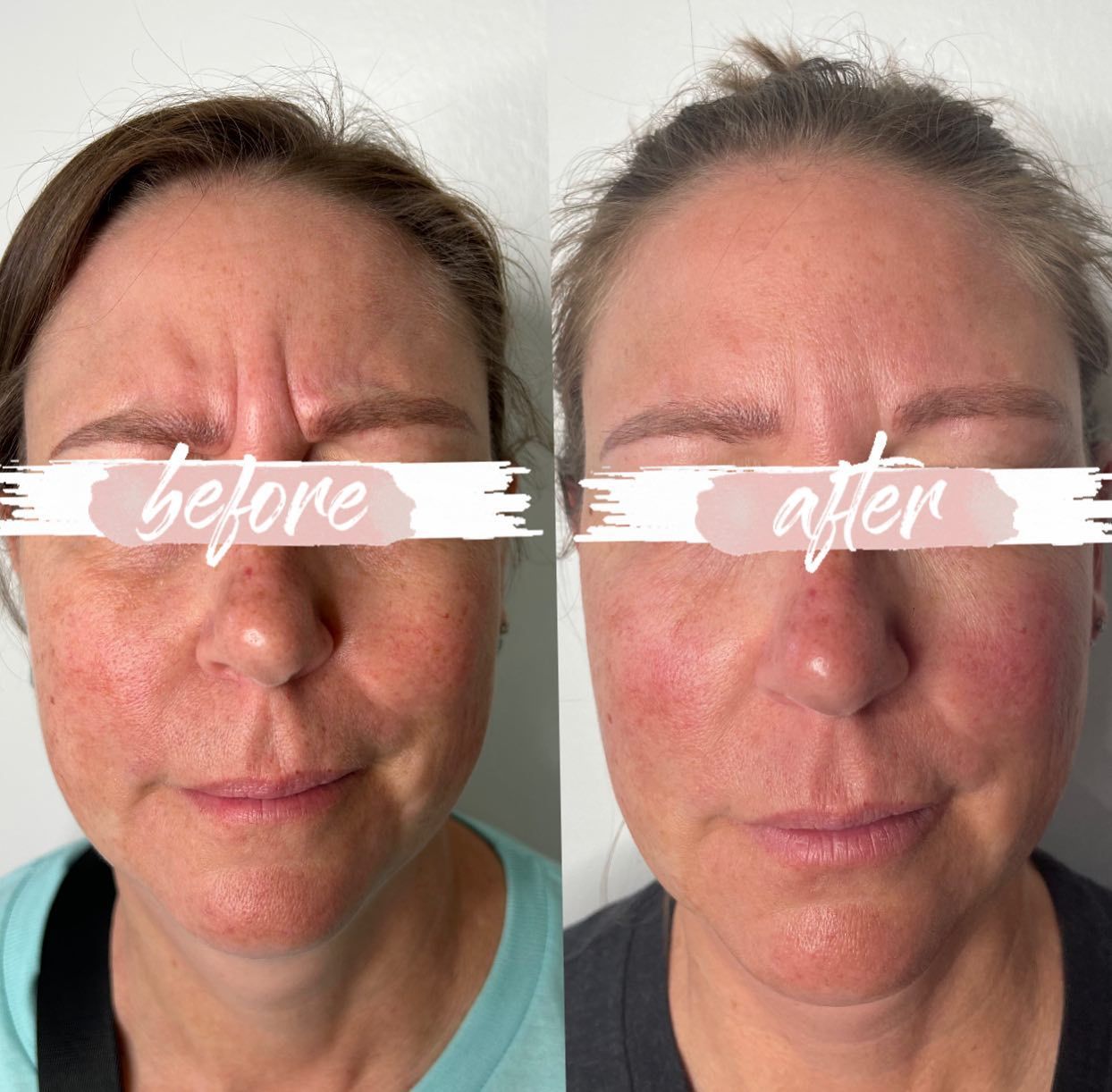 Side-by-side facial comparison labeled “before” and “after,” showing reduced redness and smoother skin.