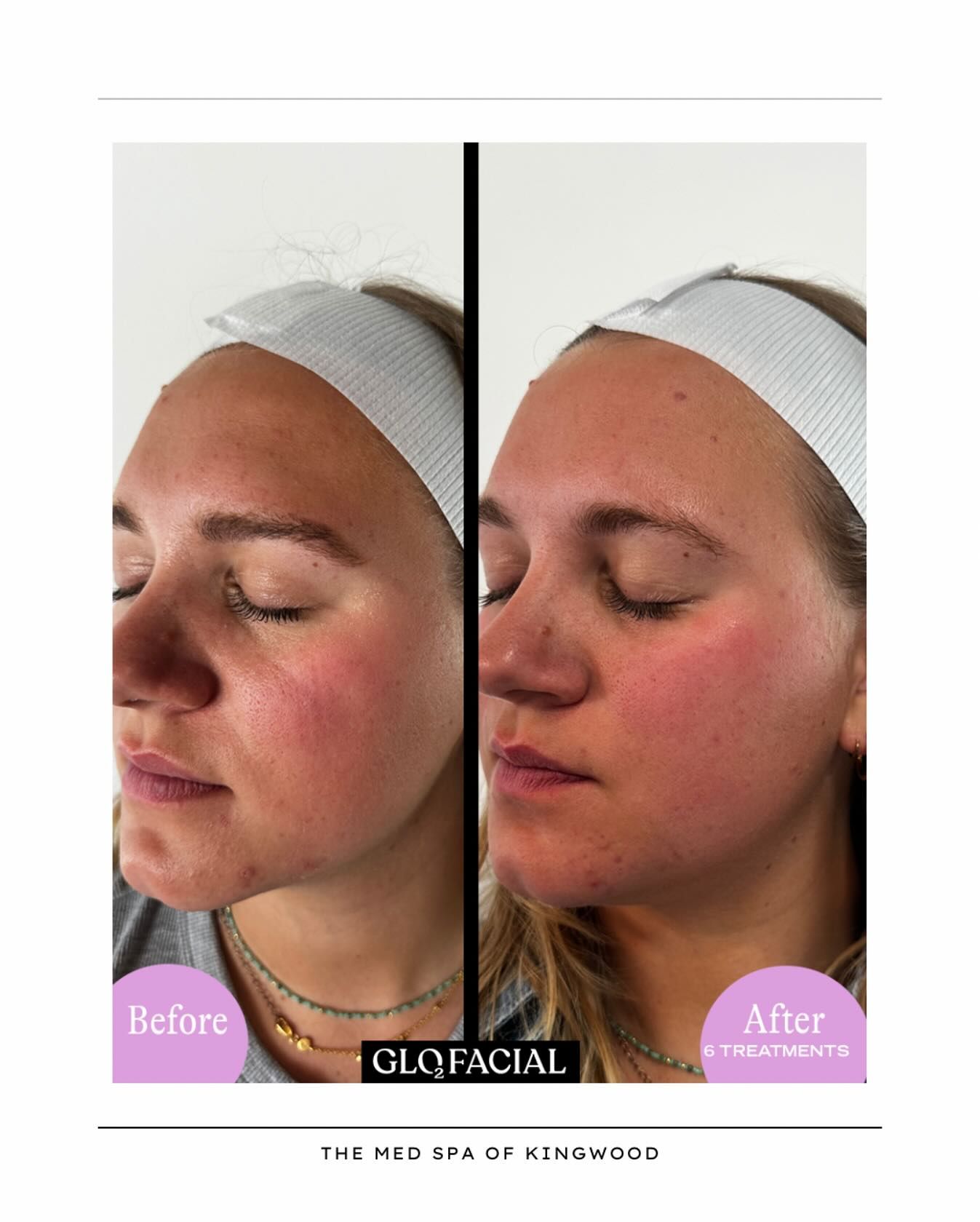 Side-by-side before-and-after facial photo showing reduced redness and puffiness after treatment