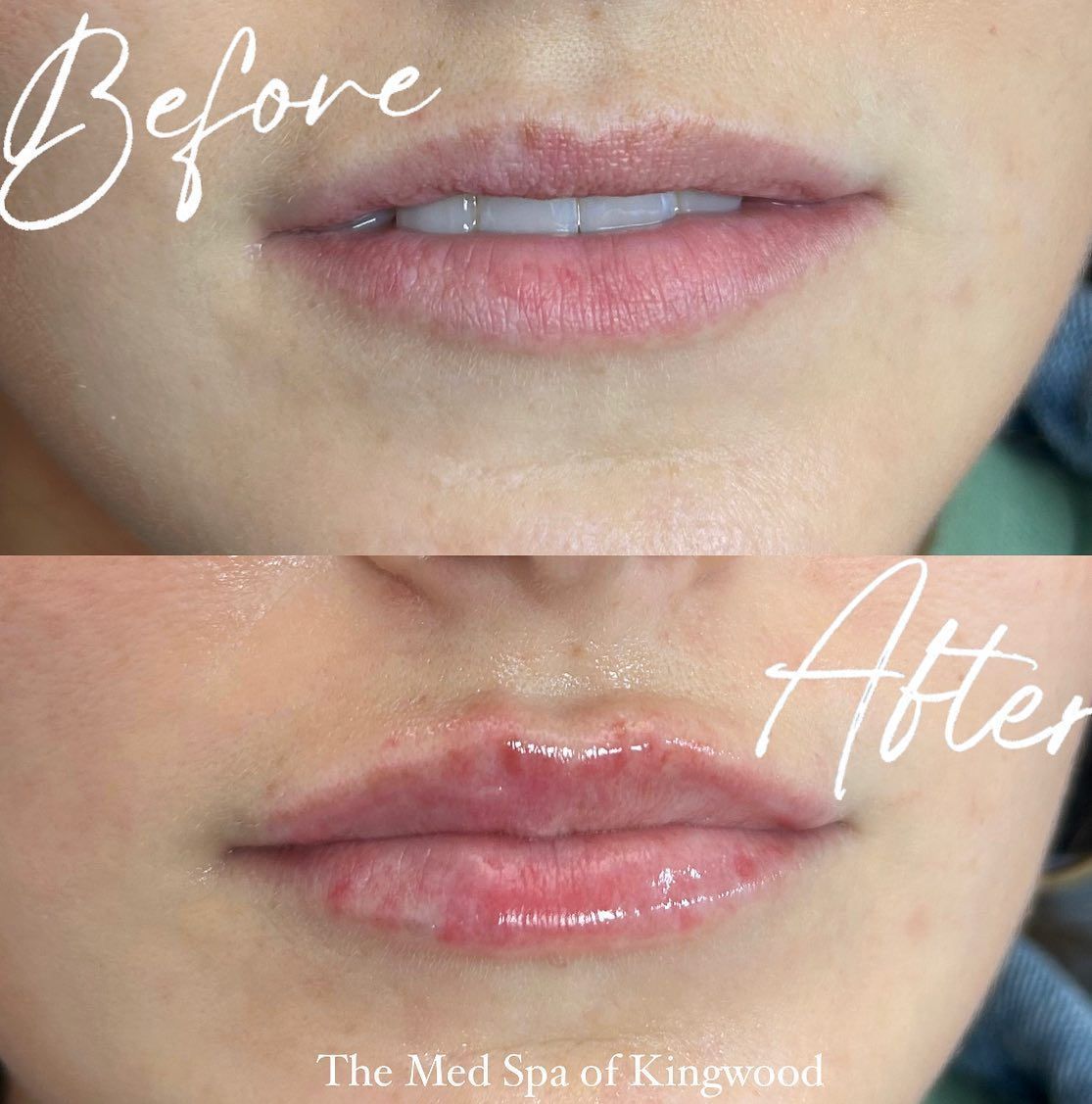 Split close-up of lips labeled “Before” and “After,” showing glossier, fuller lips after treatment