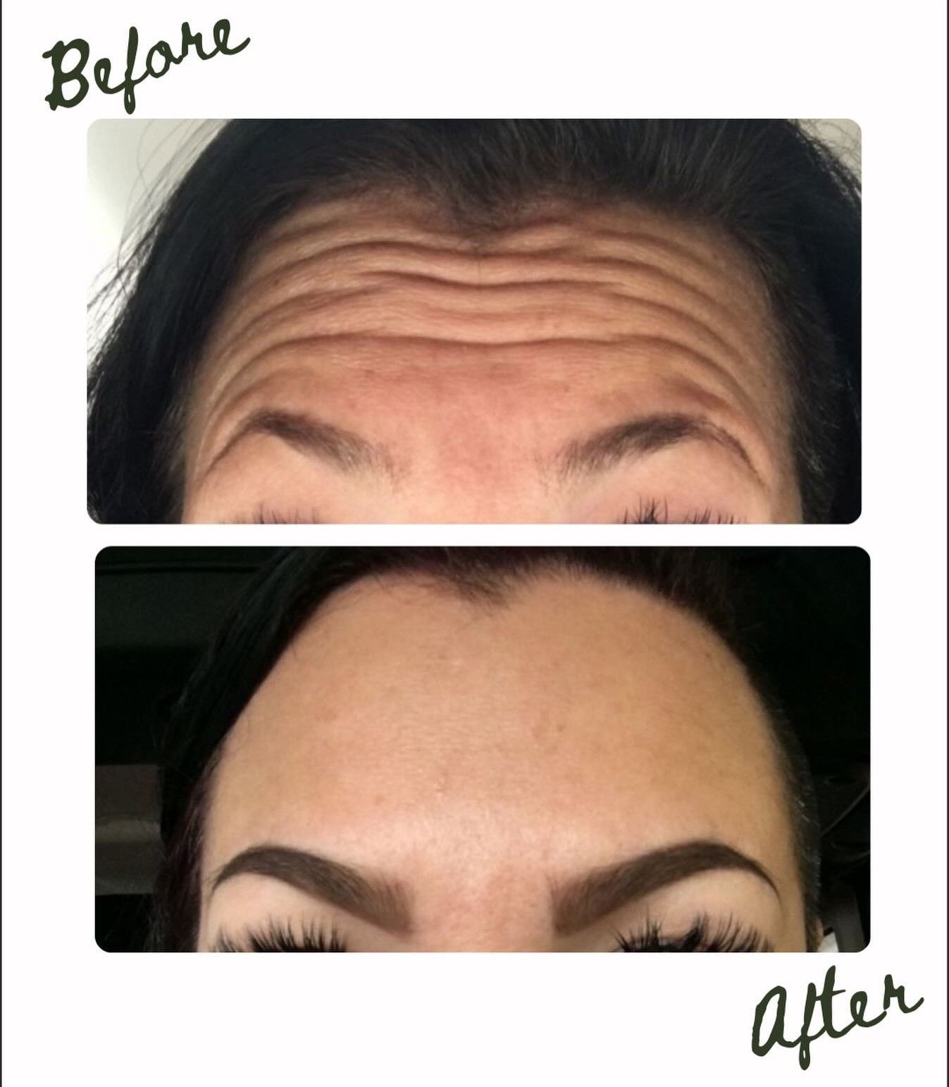 Before-and-after close-up of forehead wrinkles, showing smoother skin after treatment.