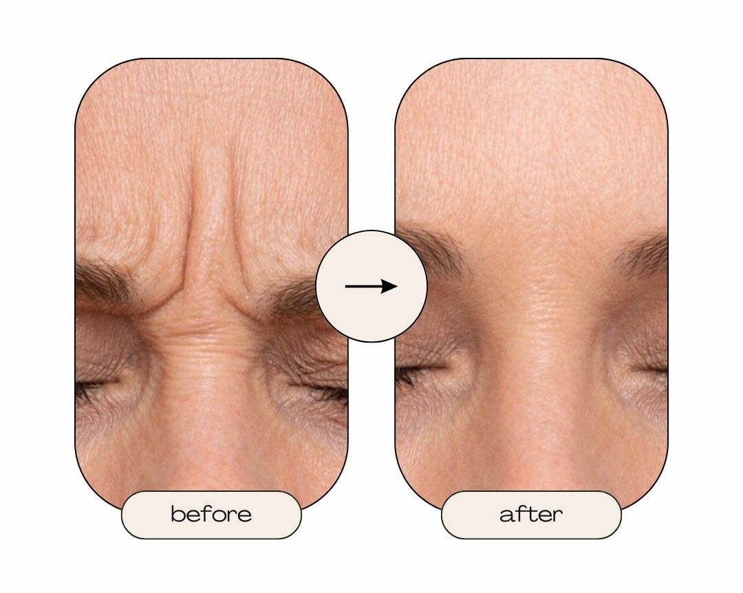 Close-up before-and-after forehead wrinkles, with smoother skin on the right and an arrow between