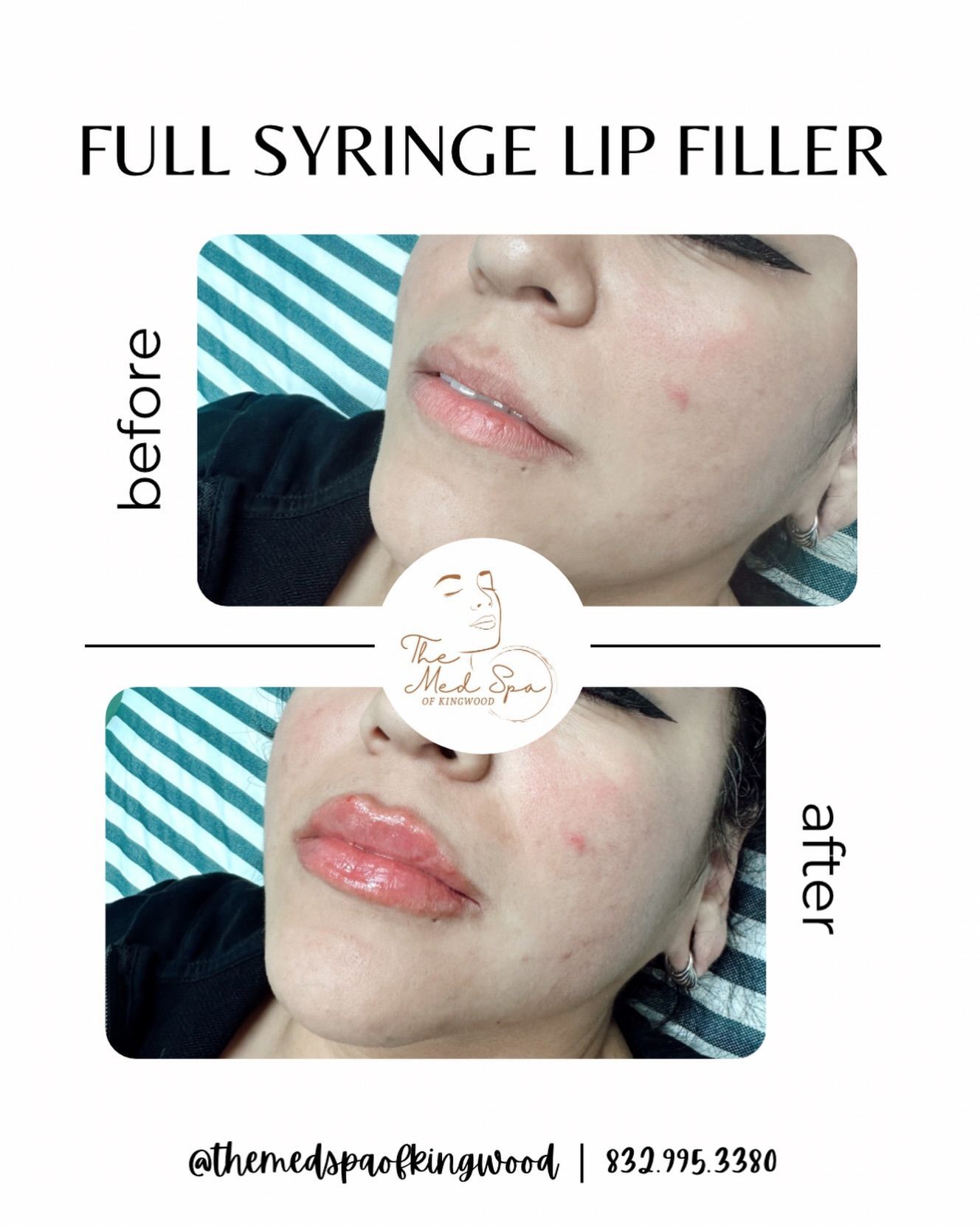 Before-and-after close-up of lips after full syringe lip filler treatment.