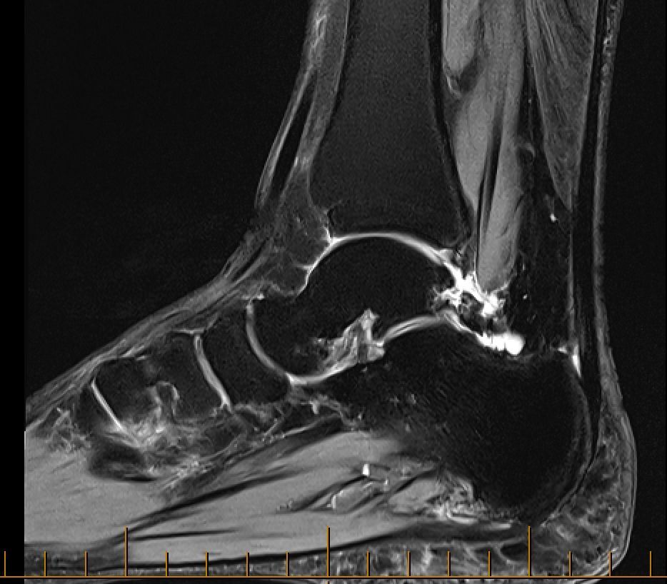 MRI of Os Trigonum Syndrome