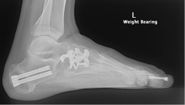 A diagram of a normal achilles tendon and an achilles tendon rupture.