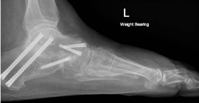 Post operative x-ray of a hindfoot fusion (triple arthrodesis).