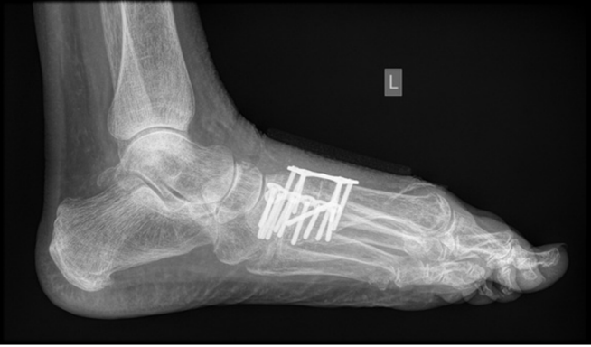 Post operative xray of a midfoot fusion (arthrodesis)