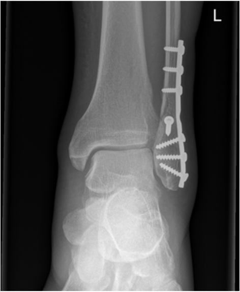 Post operative xray of a midfoot fusion (arthrodesis)