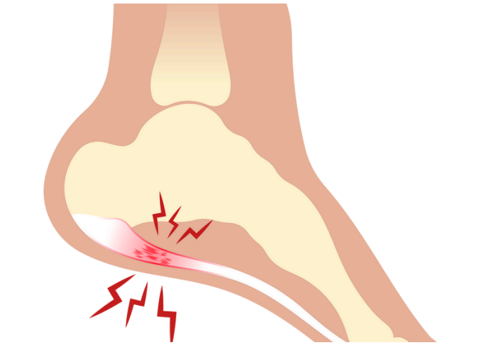 Graphic of plantar fasciitis