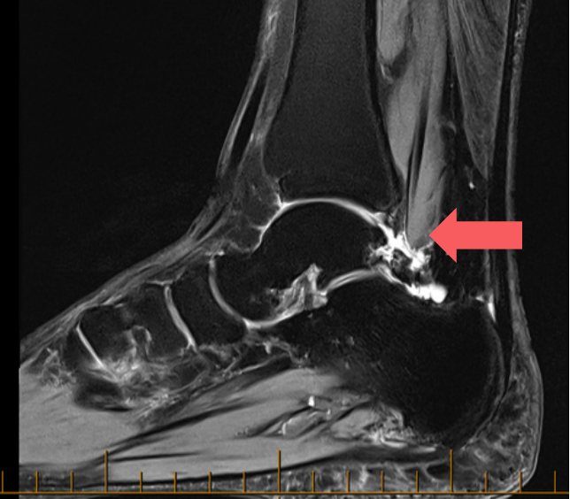 MRI showing an os trigonum
