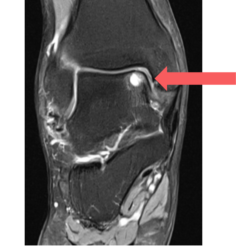 MRI of talus ostechondral defect (OCD)