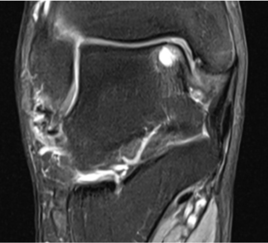 MRI scan showing insertional achilles tendinopathy with an inflamed bursa