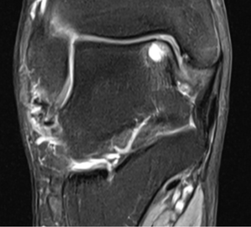MRI scan showing an osteochondral defect of the talus
