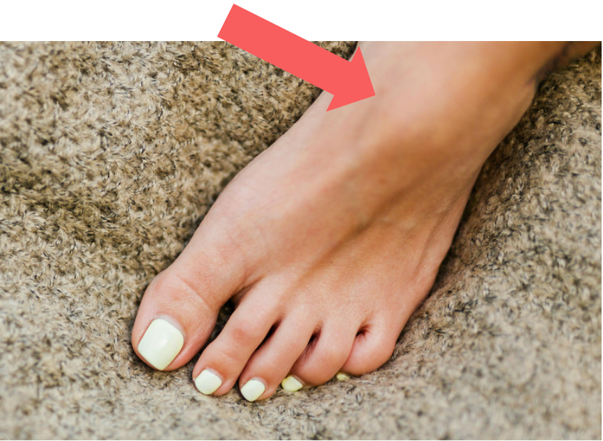 Picture of a ganglion cyst