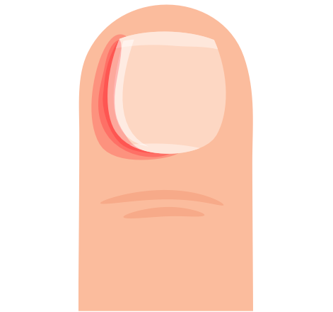 Schematic of an ingrown toenail